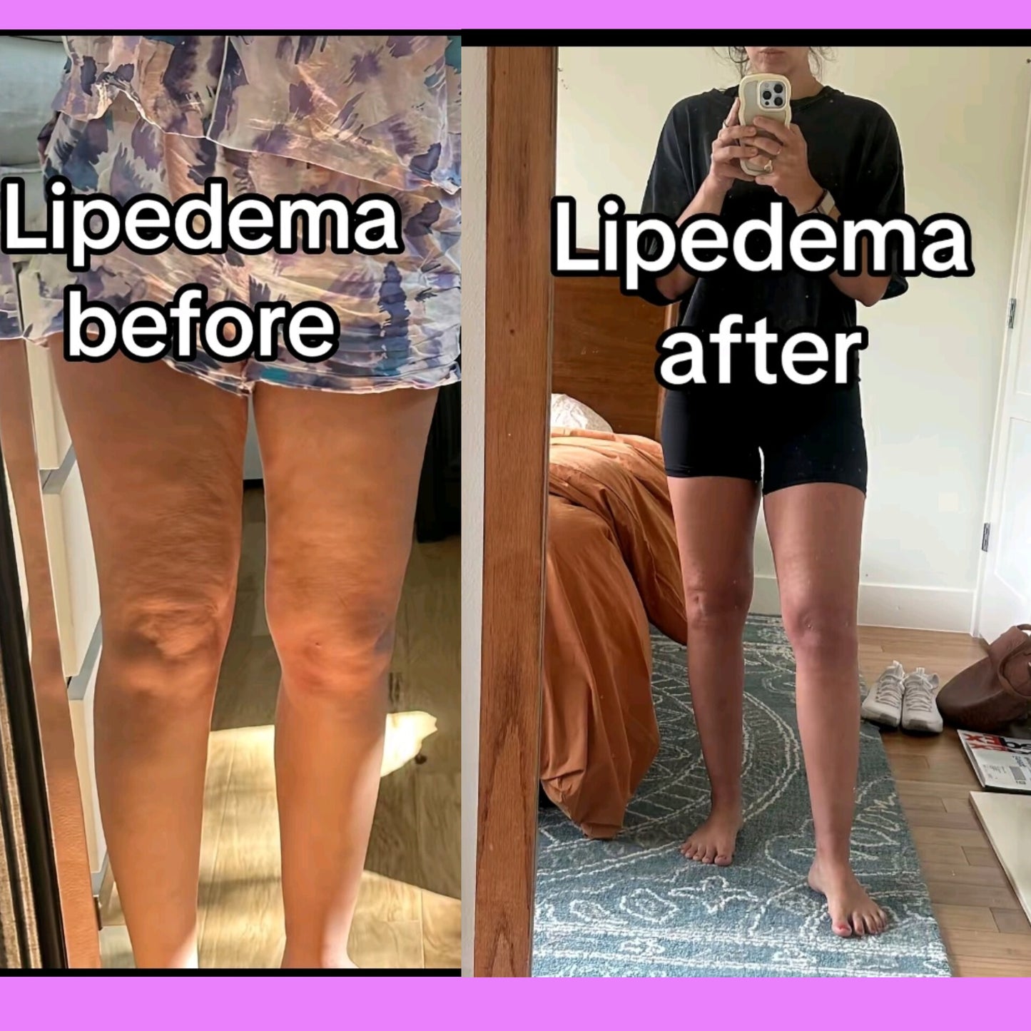 I Dare You To Hide Your Cellulite Again!