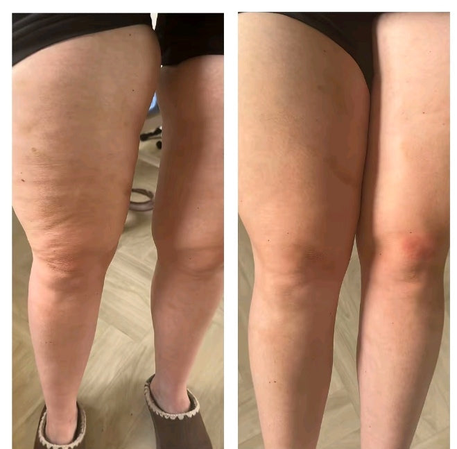 I Dare You To Hide Your Cellulite Again!